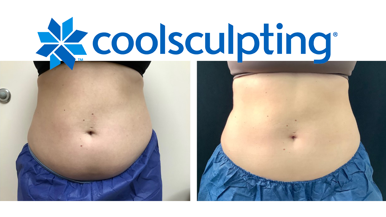 Love Handles CoolSculpting: Procedure, Results, Side Effects