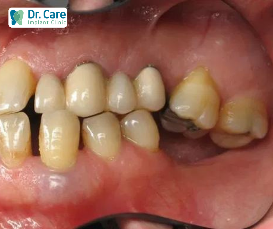 2 vị trí mất răng ảnh hưởng nghiêm trọng đến sức khỏe