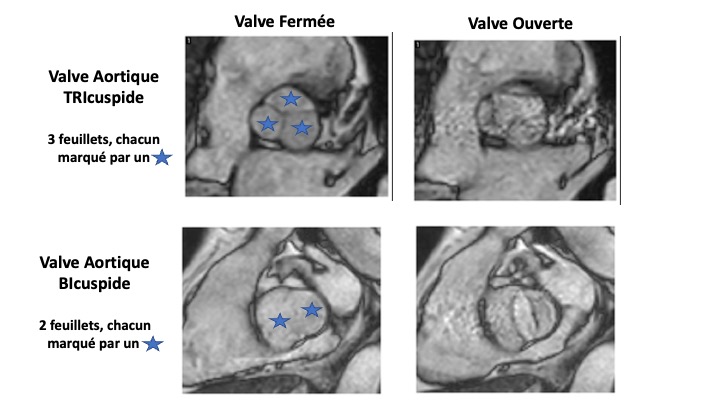 Image IRM d'une valve aortique tricuspide et d'une valve aortique bicuspide
