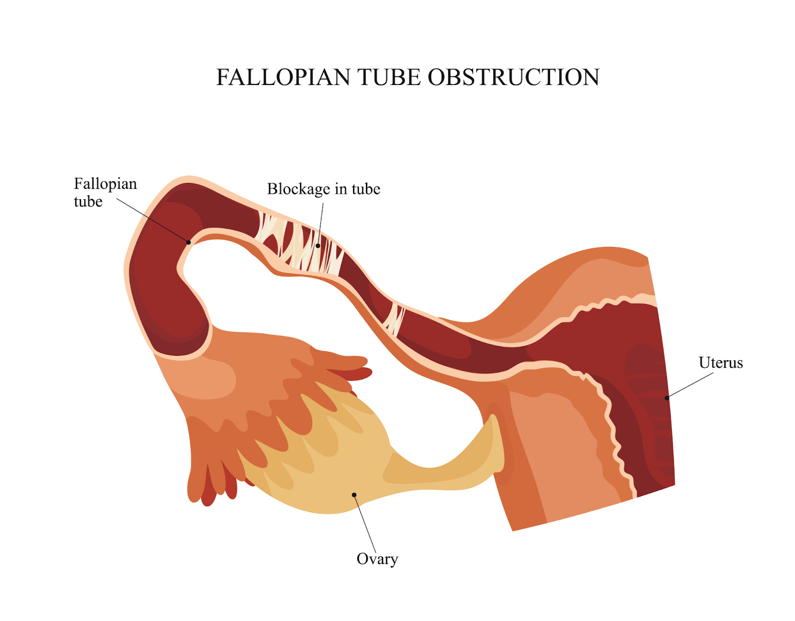 Fallopian tube obstruction