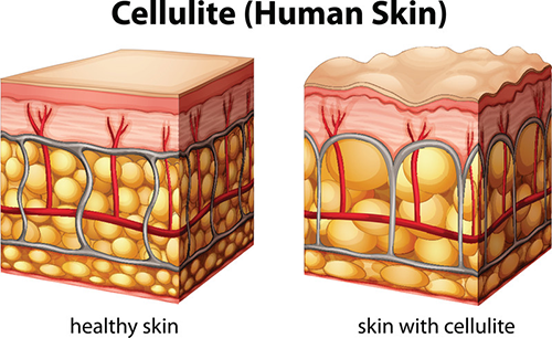 Cellulite skin