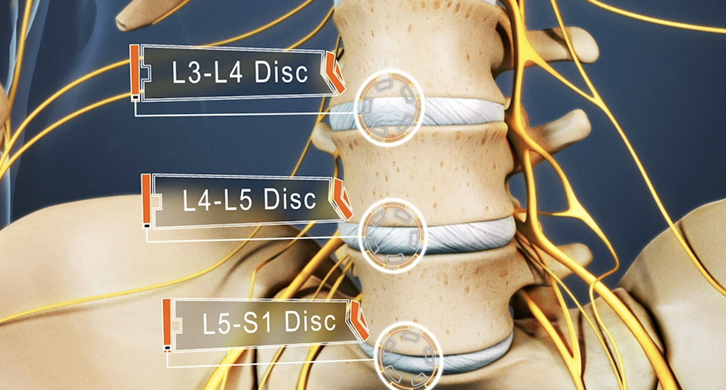 l5 s1 disc degeneration symptoms