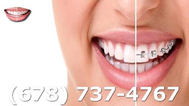 Invisalign Atlanta