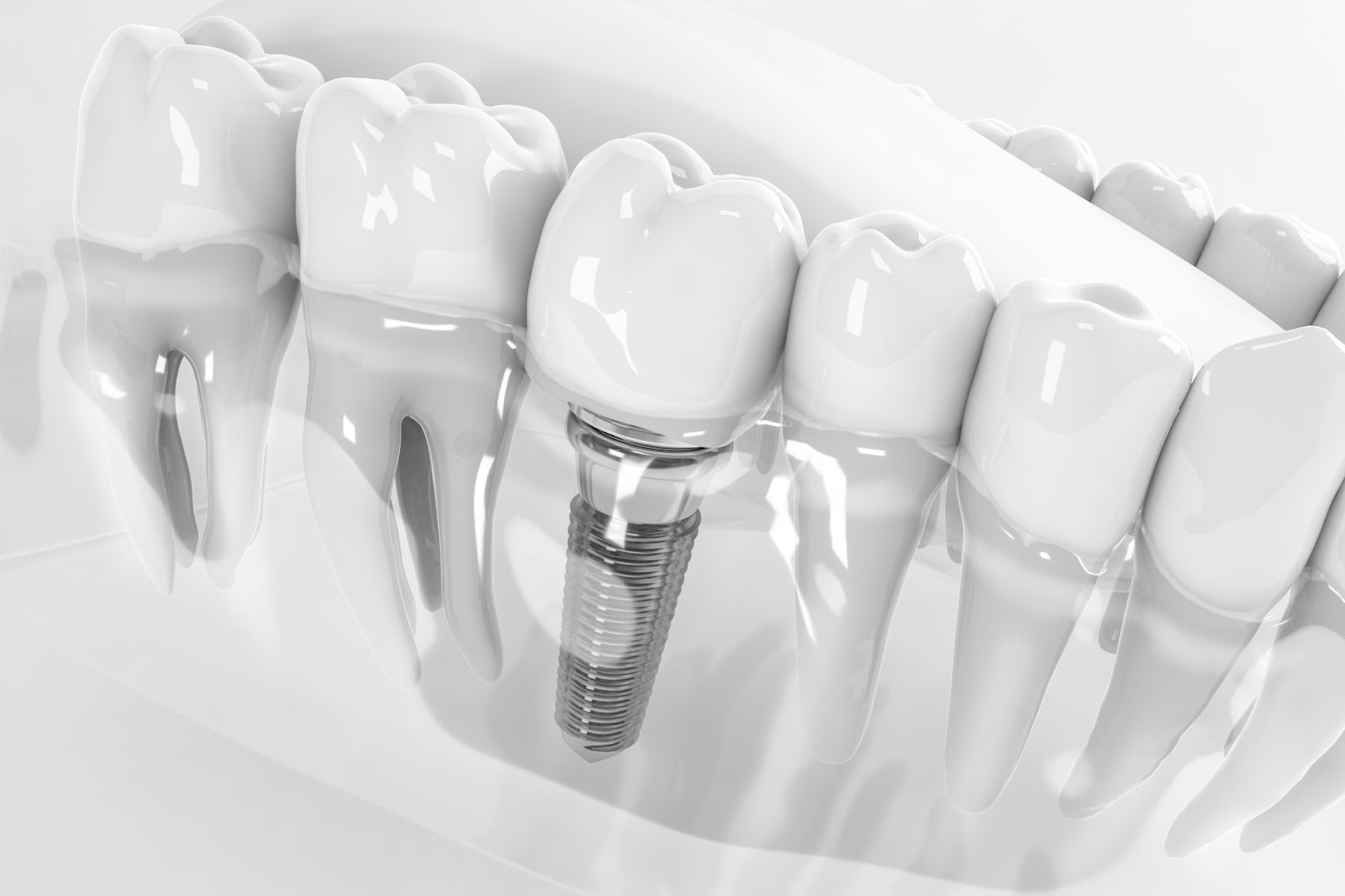 Dental Implants in Albania