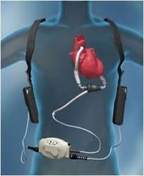 Left Ventricular Assistance Device (LVAD) – Rush Emergency Medicine