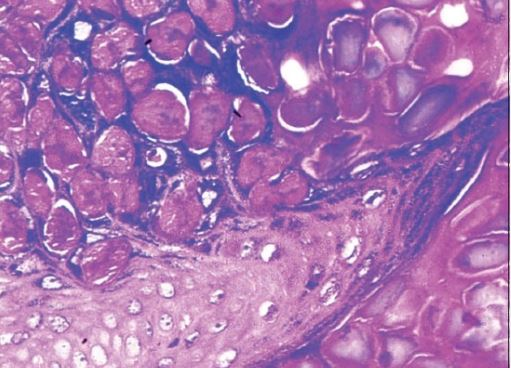 histología del molusco contagioso