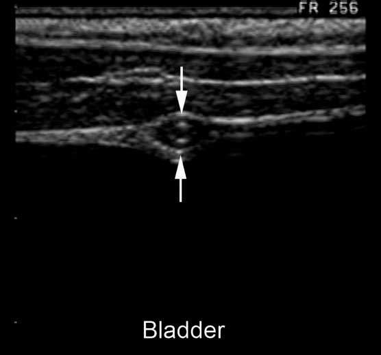 Normal umbilical artery (arrows) adjacent to bladder