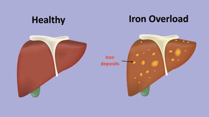 What Is Hemochromatosis? Causes, Symptoms, and Treatment