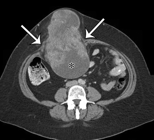 Sarcoma dei tessuti molli