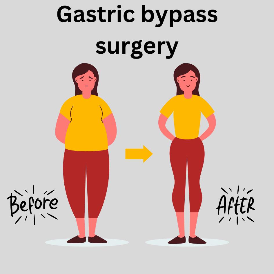 before/after gastric bypass Turkey