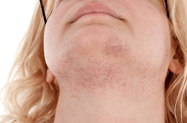 Plucking Chin Hair