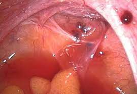 Imagens da endometriose por laparoscopia