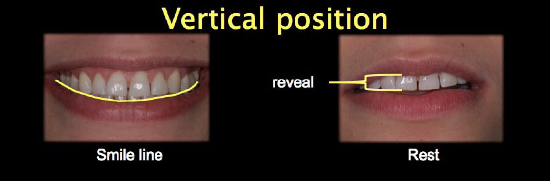 Vertical position of teeth ie is your smile line following the lip line