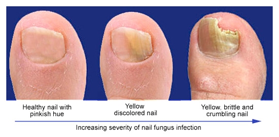 Image result for fungal nails pictures