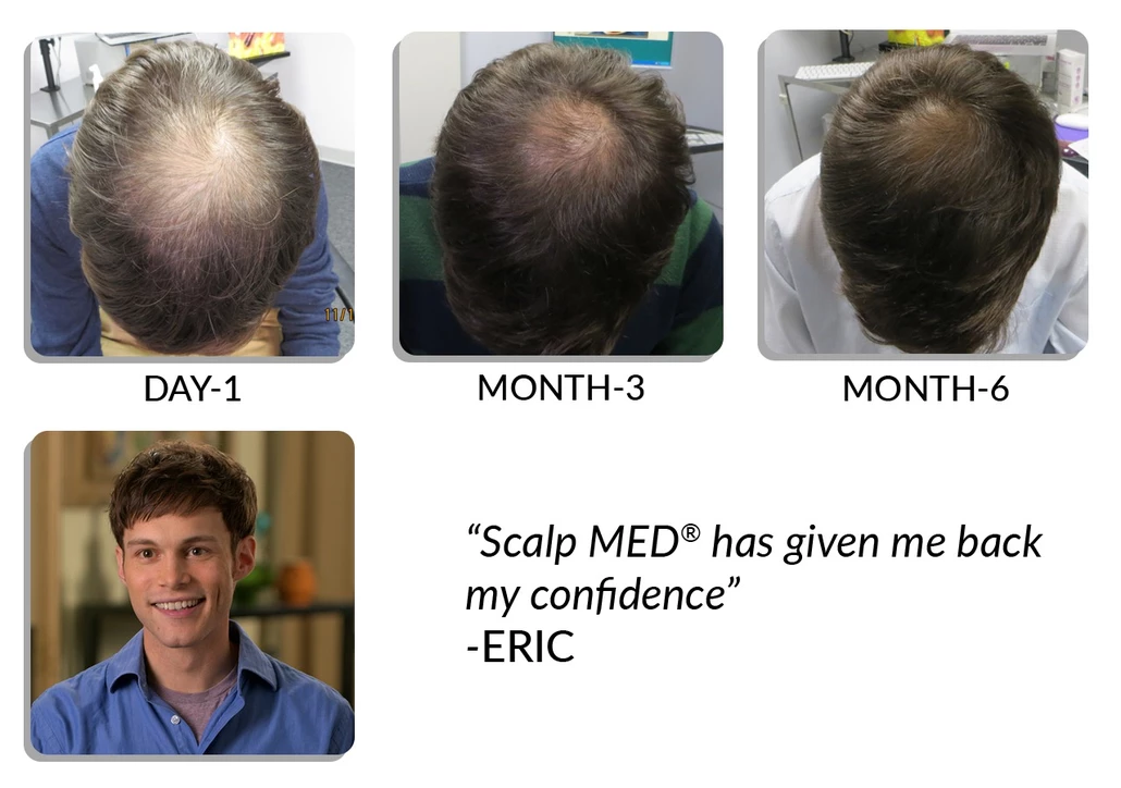 Scalp Med before and after