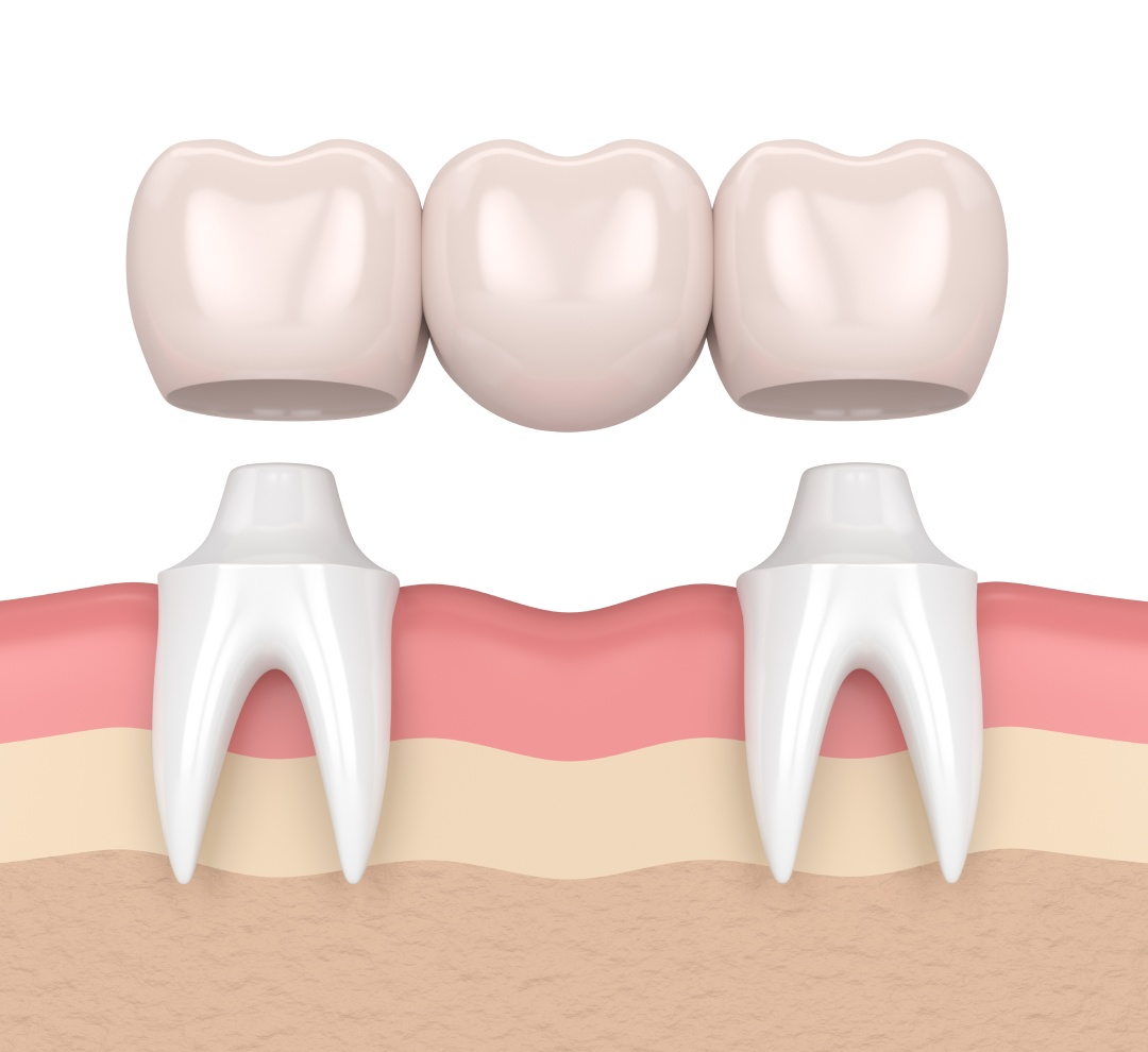 Dental Crowns vs. Bridges