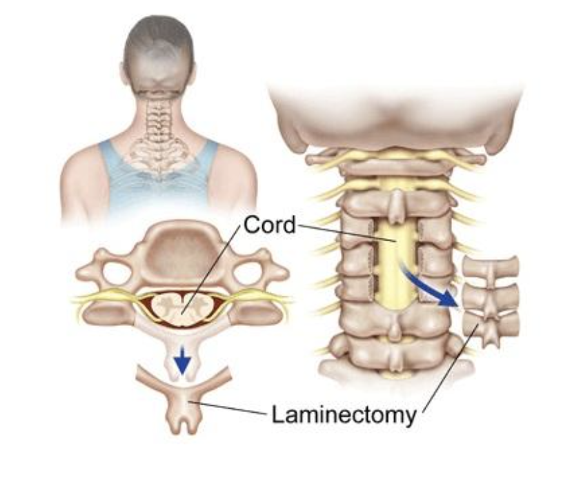 laminectomy-neck-surgery