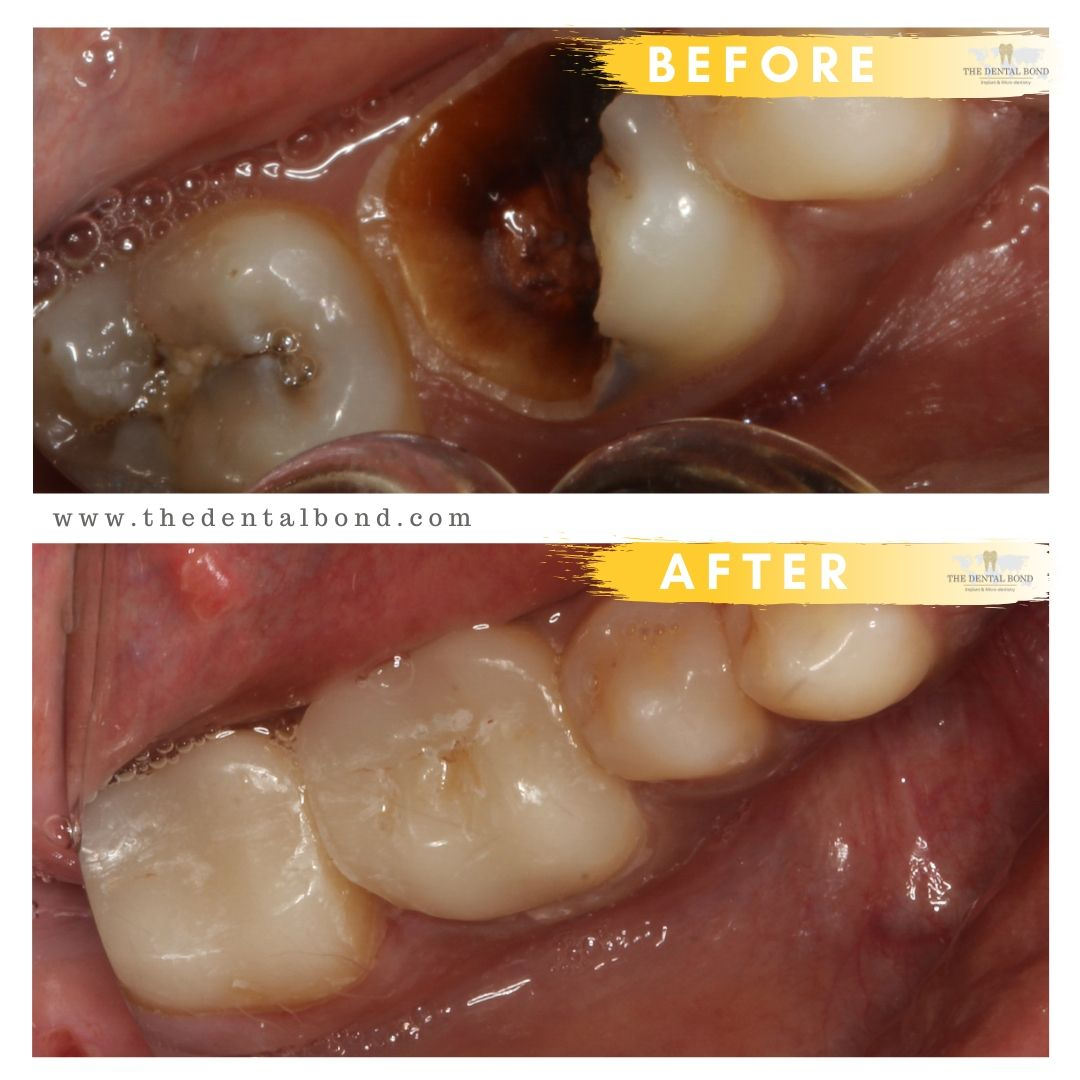 Tooth decay before and after picture