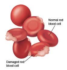 Hemolytic Anemia, When Your Child Has
