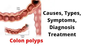 What are colon polyps
