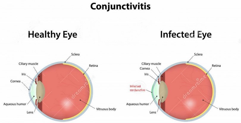 Conjunctivitis eye diagram