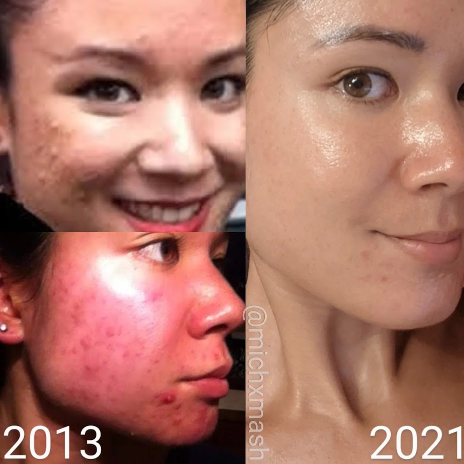 CO2 Fraxel Laser Review - Did My Old Atrophic Acne Scars Improve? -  MICHXMASH