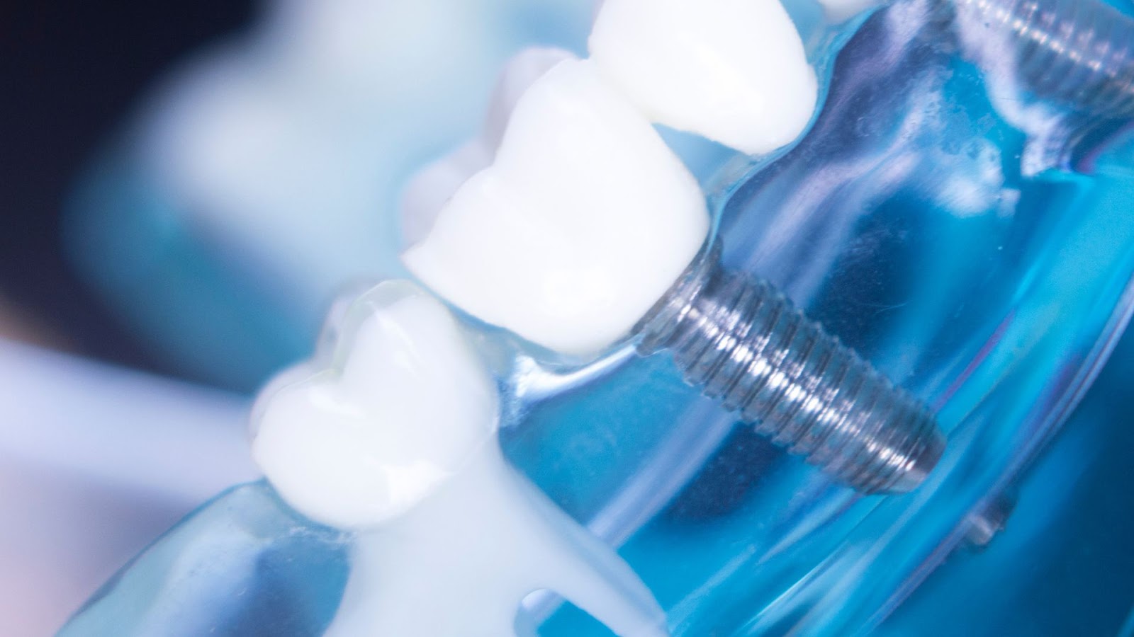 Dental Implant Marketing - 7 Exciting Steps to Modern Dental Implants