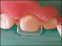dental implant clinic Delhi