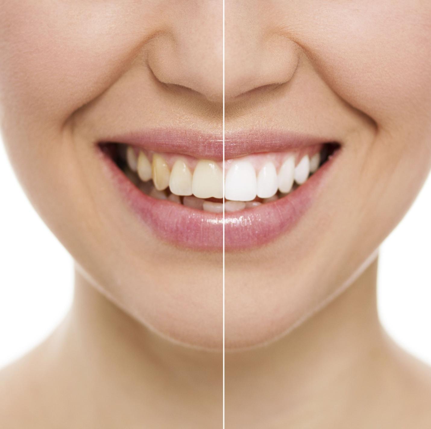 professional teeth whitening in Vancouver 