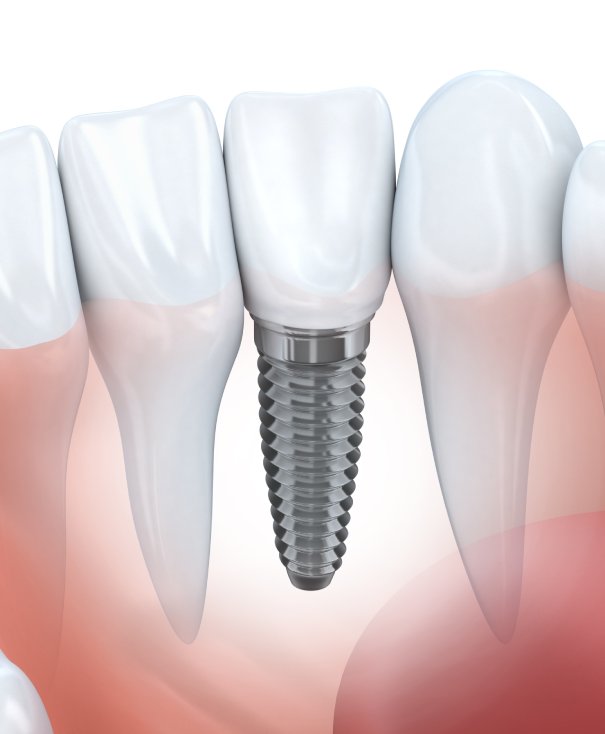 Dentures on Quality of Life