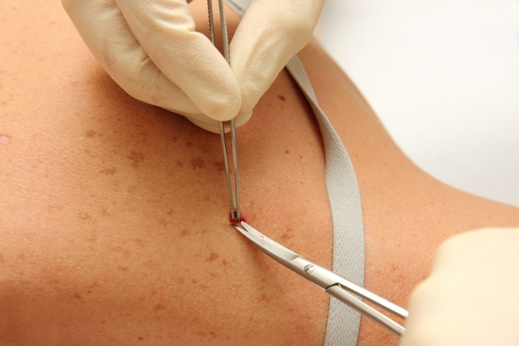 How I Healed My Mother Skin Cancer At Home
