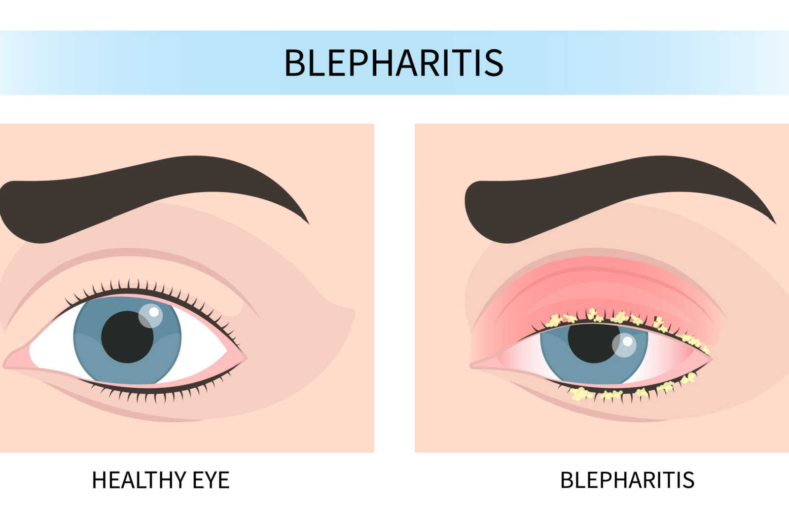 Comparison the appearance of a of normal eye against an eye affected with blepharitis.