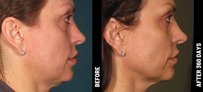 รีวิว Ulthera เปรียบเทียบก่อน-หลังทำ รีวิว Ulthera เปรียบเทียบก่อน-หลังทำ