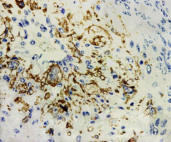 Positive cytokeratin stain of trophoblast that has infiltrated the myometrial blood vessel whose lumen is at 11 o'clock.