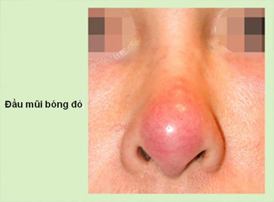 Nâng mũi bị đỏ đầu mũi, dần dần sau 5 - 7 ngày sẽ biến mất hoàn toàn với các trường hợp mũi bị bóng đỏ theo phản ứng tự nhiên của cơ thể.