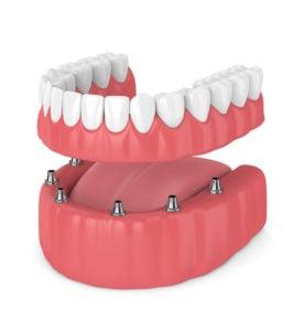 fixed implant denture NewMouth