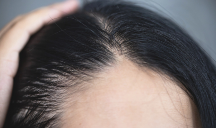 PRP Treatment for Hair Loss and Hair Thinning 