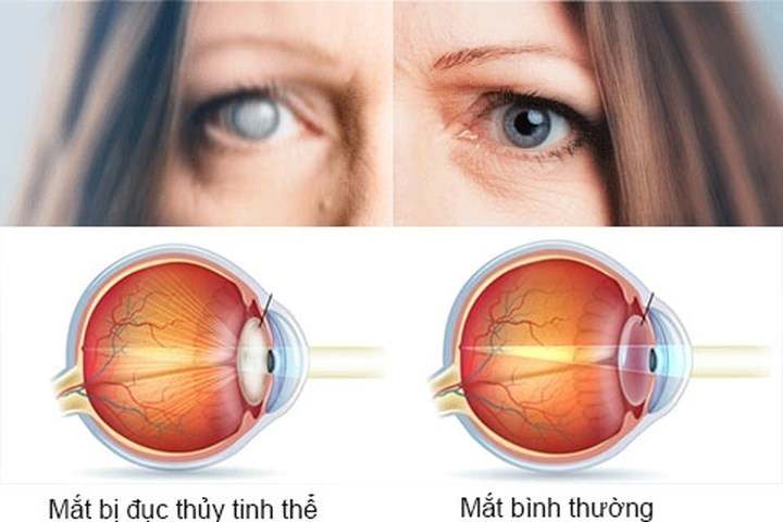 So sánh mắt bị đục thủy tinh thể và mắt bình thường