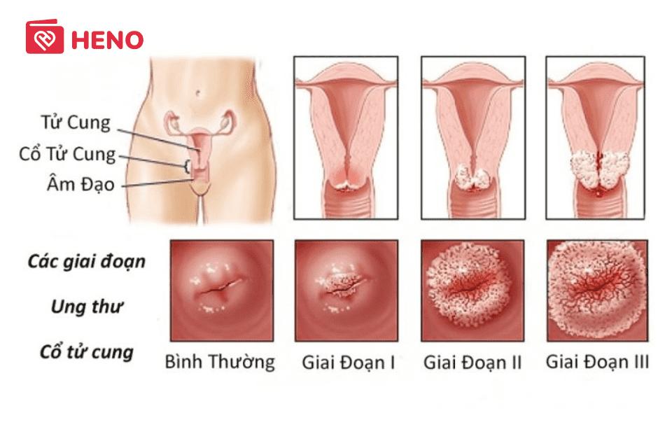 Ung thư cổ tử cung qua từng giai đoạn