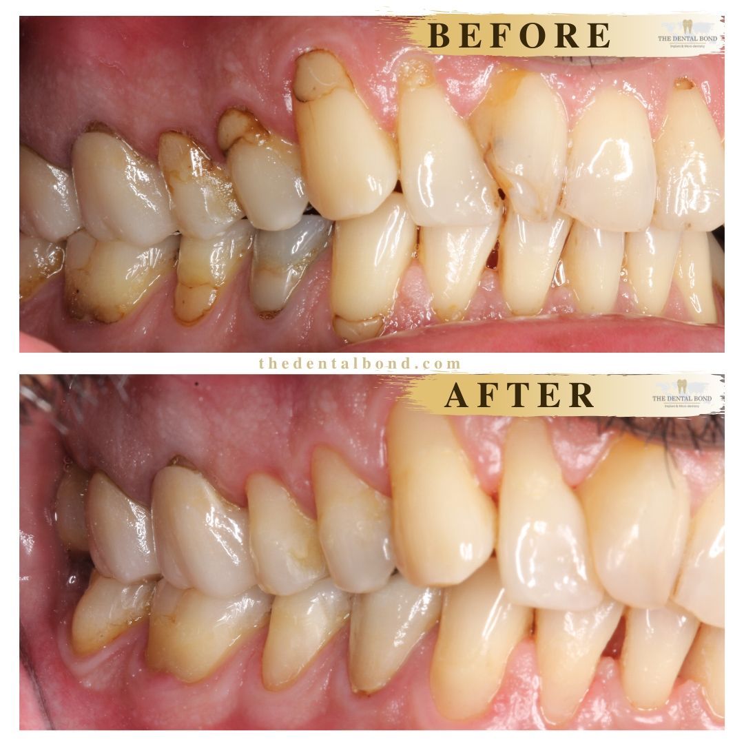 Tooth treatment before and after