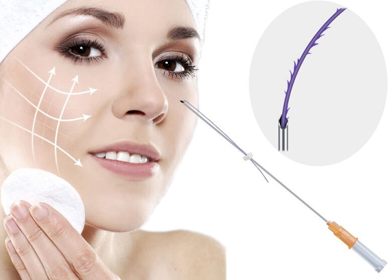 Căng da mặt bằng chỉ hay còn gọi là căng da mặt bằng chỉ collagen là thủ thuật đưa sợi chỉ collagen sinh học chuyên dụng vào lớp trung bì của da.