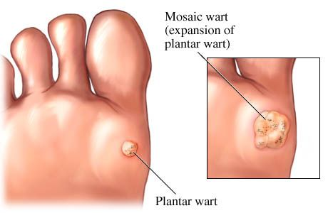 picture of plantar warts