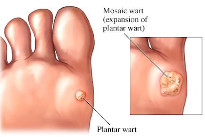 15+ Plantar Wart Callus