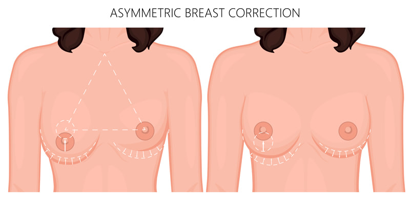 Breast Asymmetry Surgery In Perth | Subiaco Plastic Surgery