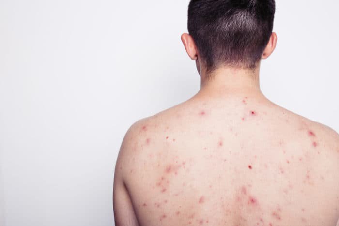 Phát ban da do nhiễm HIV