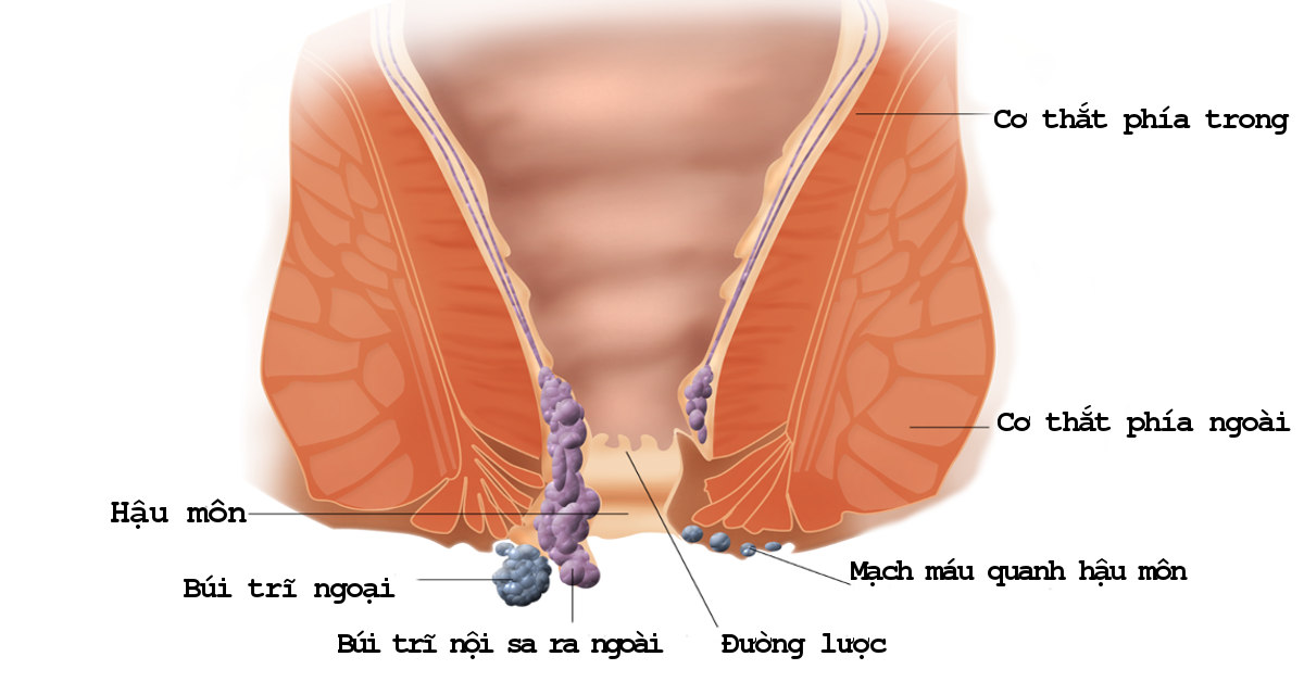 triệu chứng bệnh trĩ nội