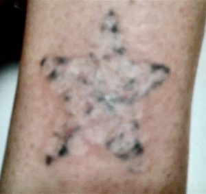 Tattoo removal Lasers outshine other methods