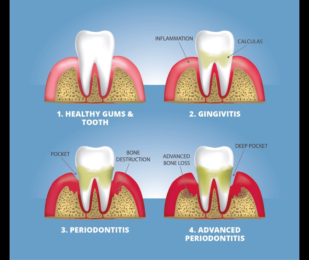 Does Gum Disease Go Away When Teeth Are Removed