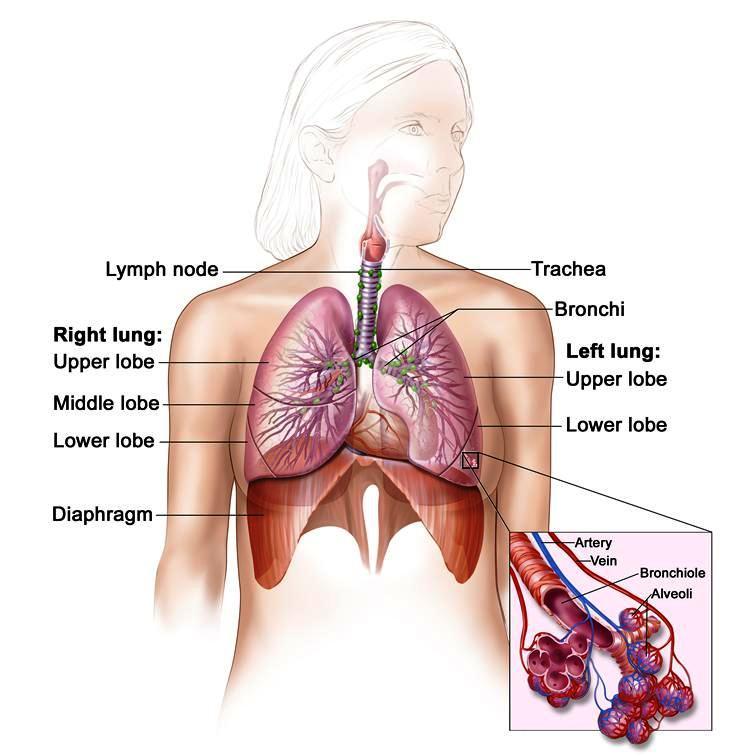 Αποτέλεσμα εικόνας για καρκίνος του πνεύμονα