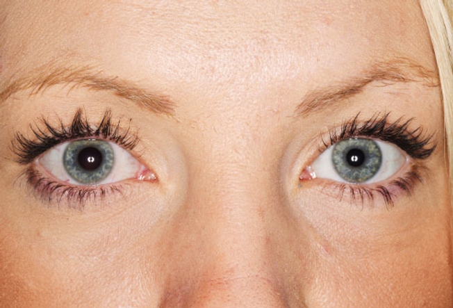 สีของดวงตาและรูปร่างบอกอะไรเกี่ยวกับสุขภาพของคุณได้บ้าง ! 8